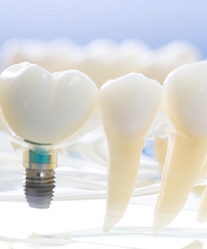 plastic model if a single dental implant